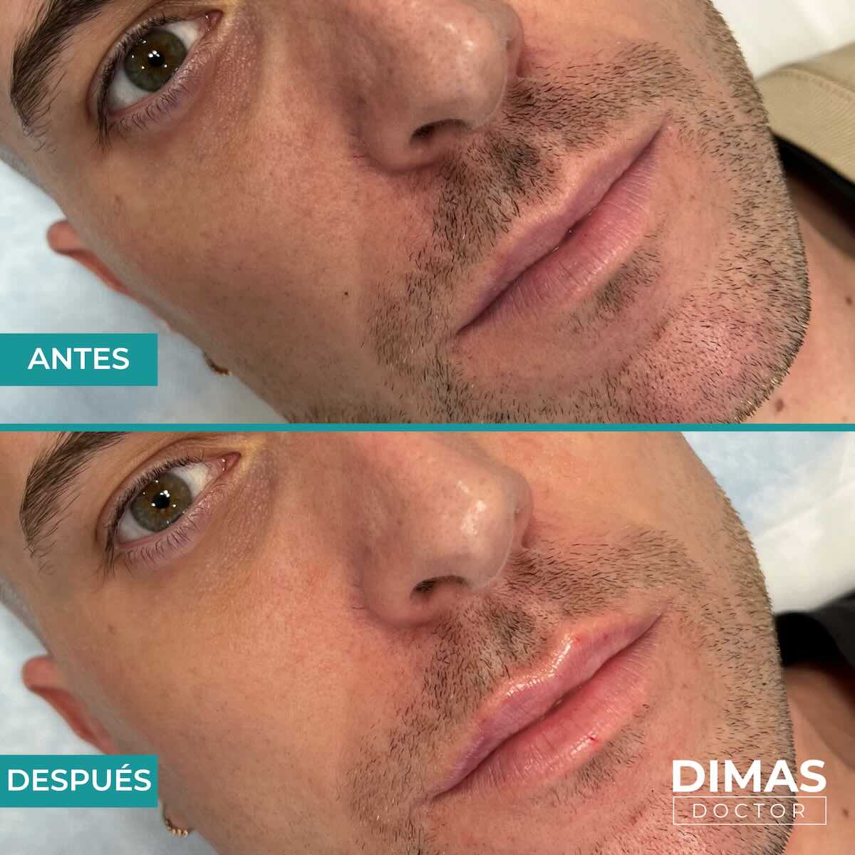 Relleno de labios con ácido hialurónico en hombres