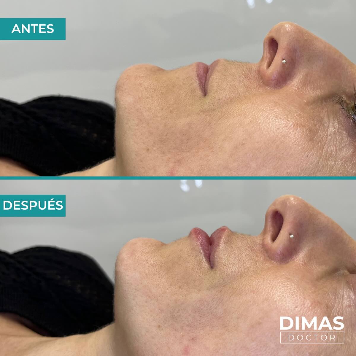 Relleno de labios con ácido hialurónico en mujeres