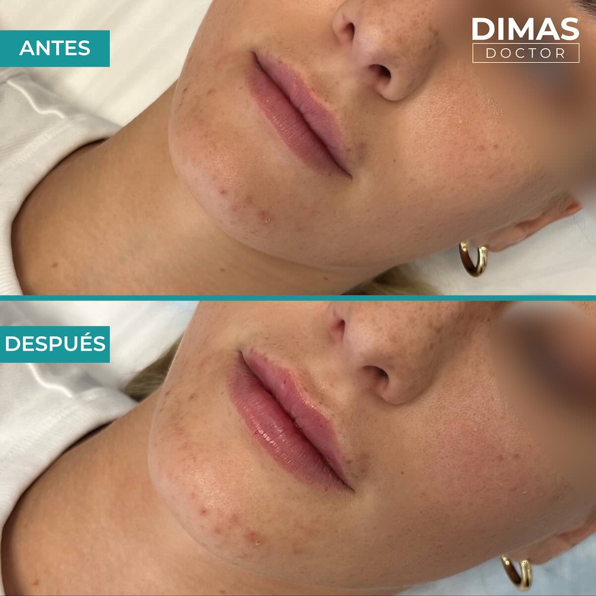 Relleno de labios con ácido hialurónico en mujeres