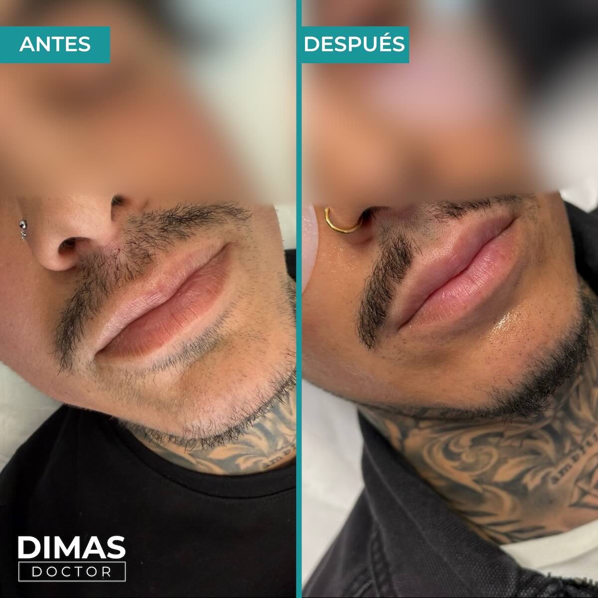 Relleno de labios con ácido hialurónico en hombres