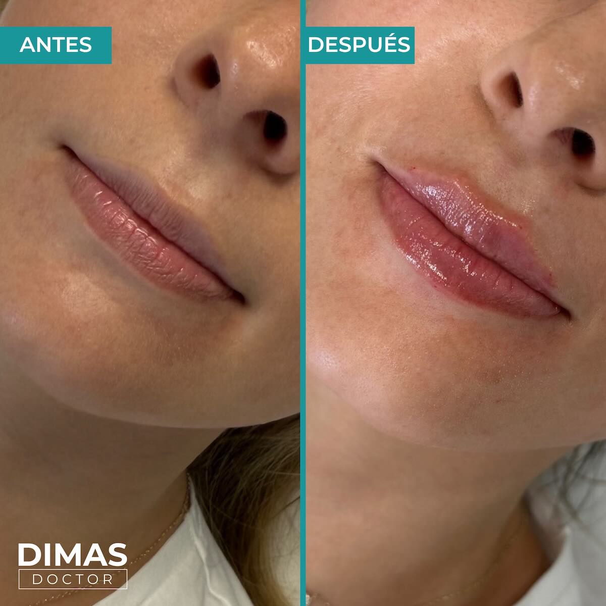 Relleno de labios con ácido hialurónico en mujeres