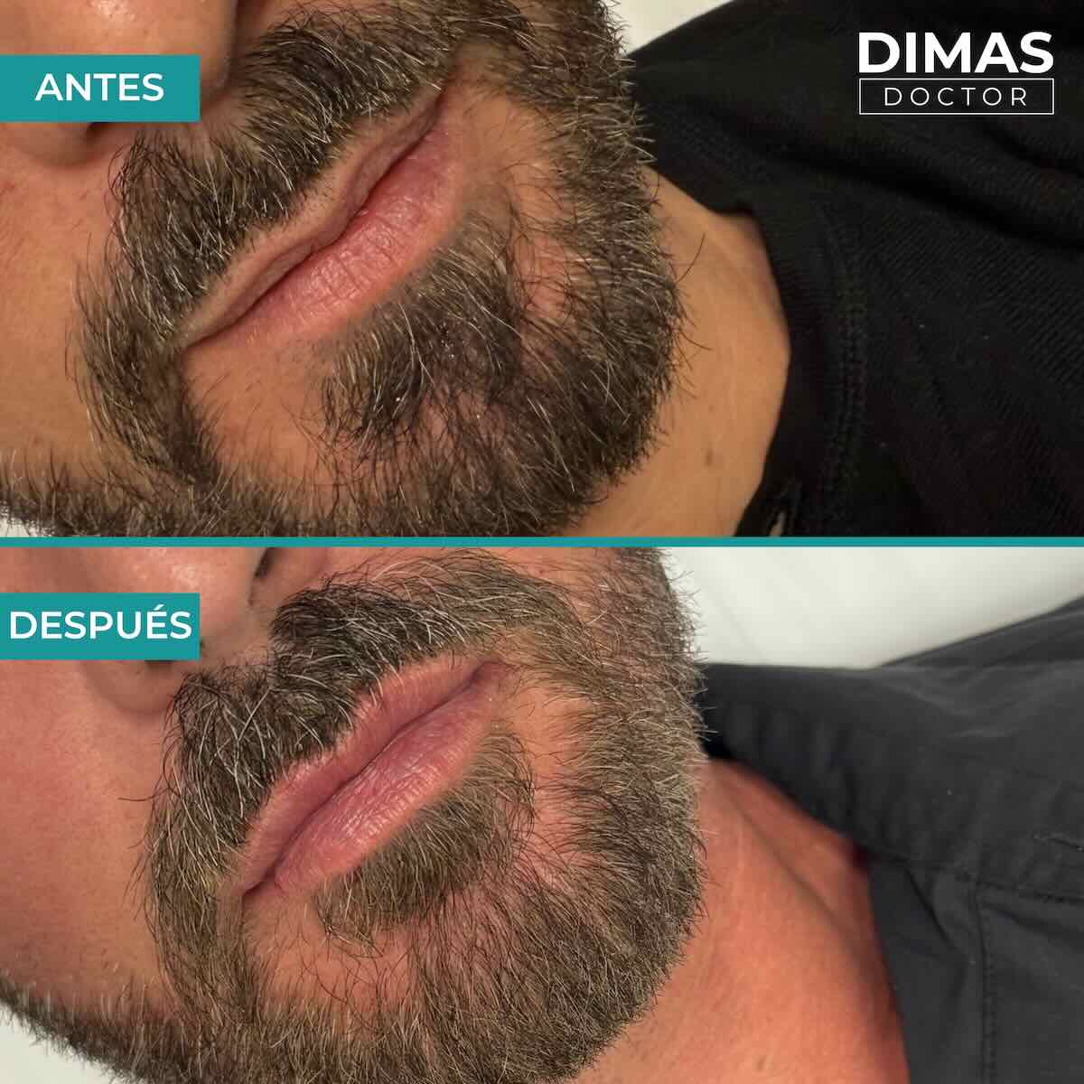 Relleno de labios con ácido hialurónico en hombres