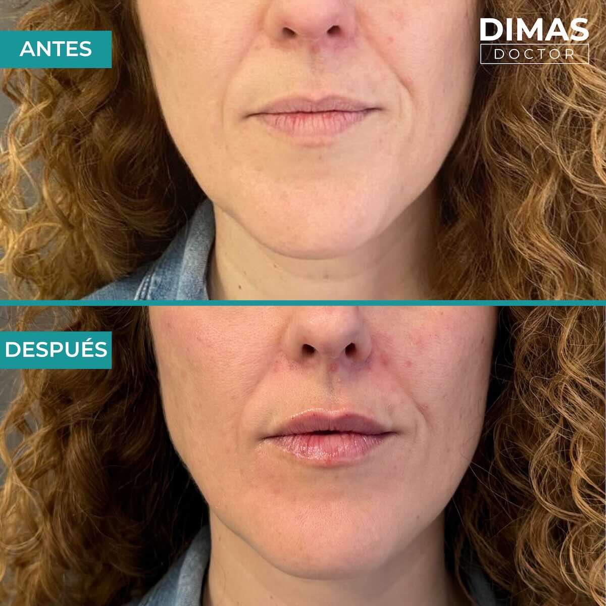 Relleno de labios con ácido hialurónico en mujeres