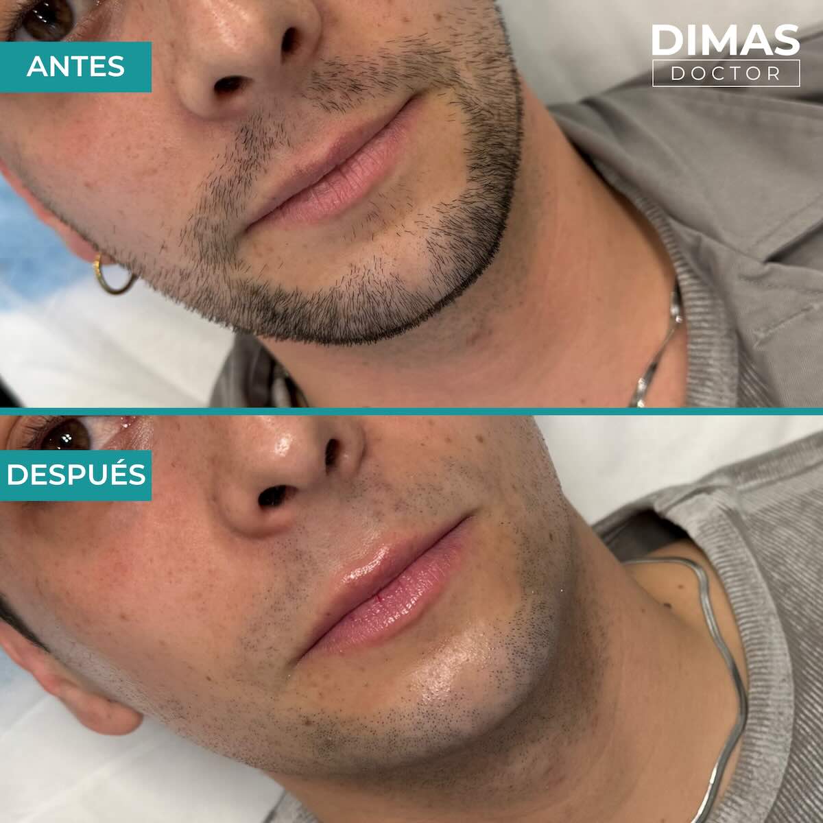 Relleno de labios con ácido hialurónico en hombres