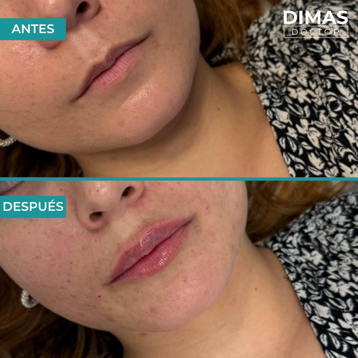 Relleno de labios con ácido hialurónico en mujeres