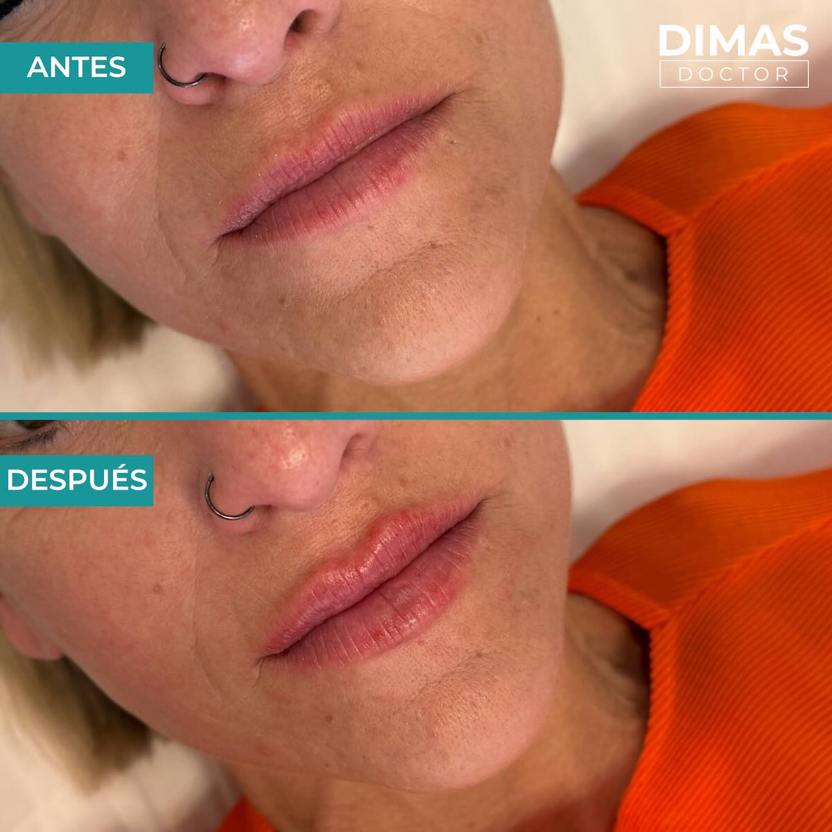 Relleno de labios con ácido hialurónico en mujeres