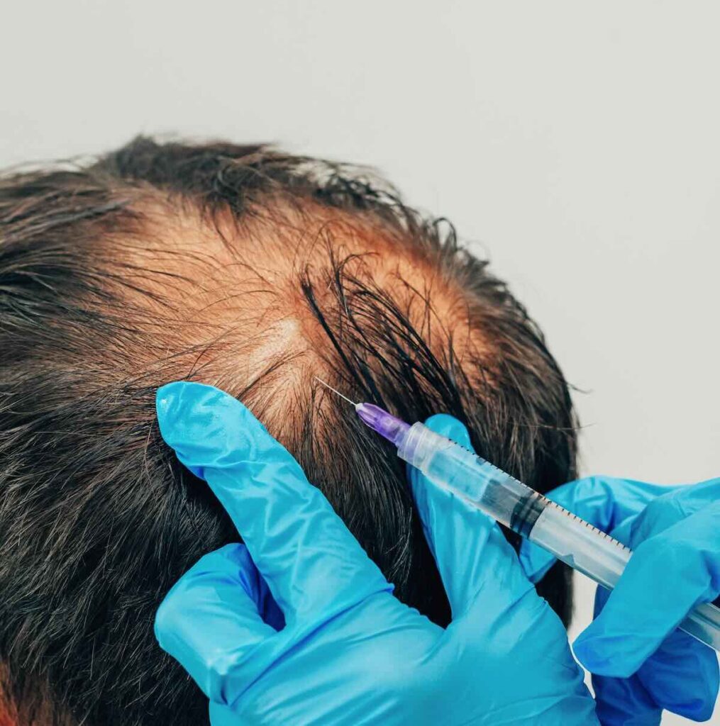 Pinchando en el cuero cabelludo para tratar caída cabello