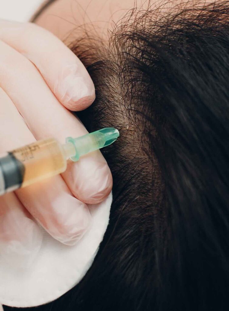 Tratamiento inyectando con mesoterapia en cuero cabelludo para alopecia