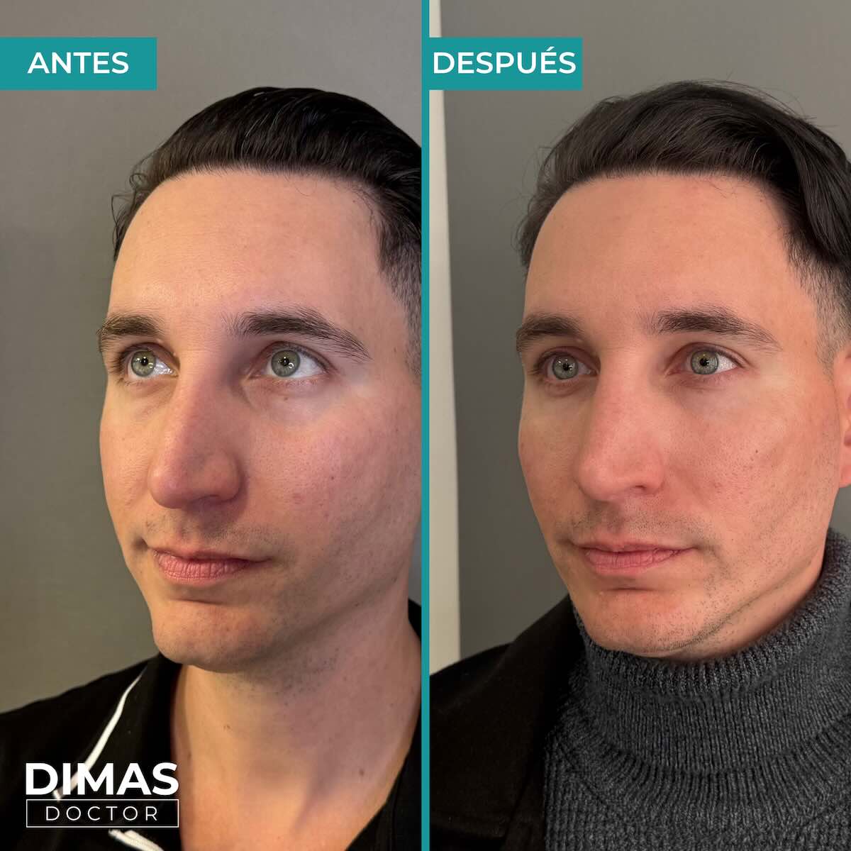 Armonización facial en hombre con ácido hialurónico