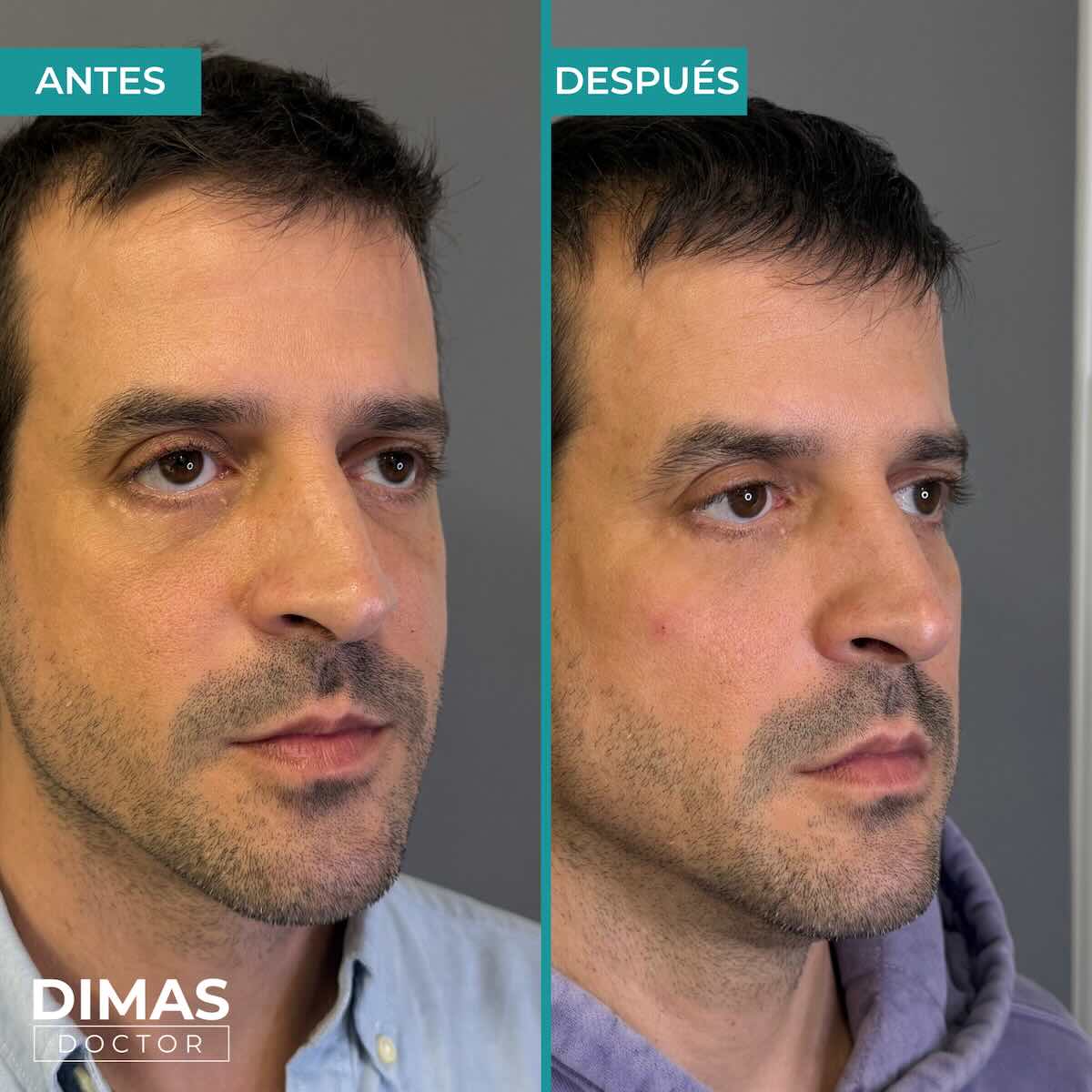 Armonización facial en hombre con ácido hialurónico