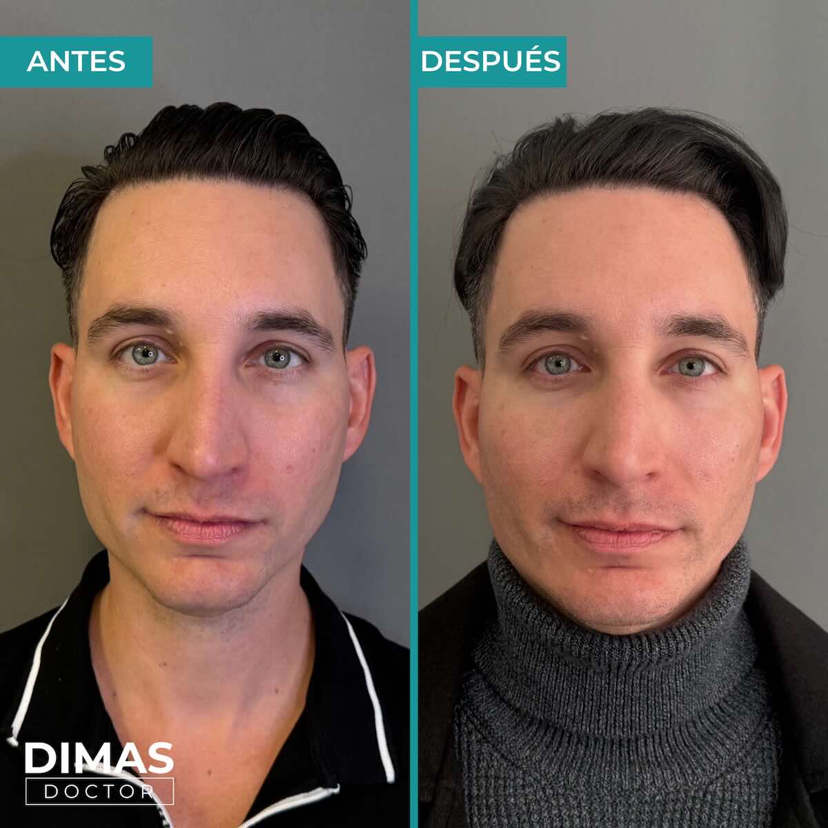 Armonización facial en hombre con ácido hialurónico