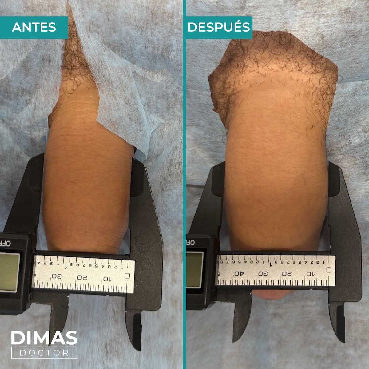 Antes y después de engrosamiento de pene