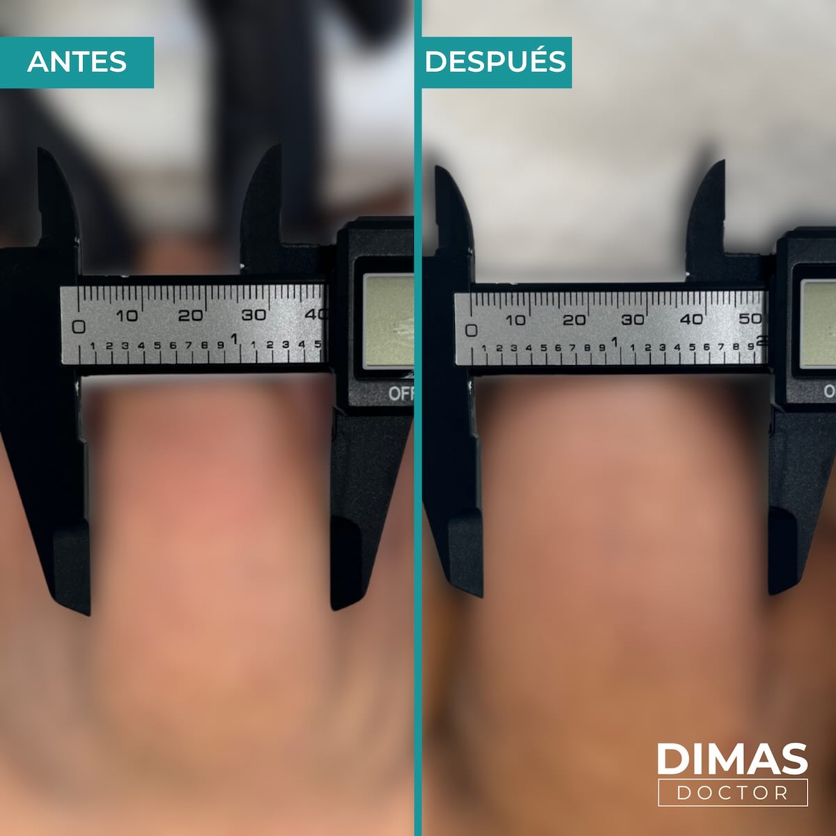 Antes y después de engrosamiento de pene