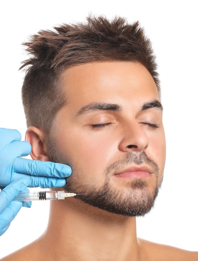 Resultados de marcación mandibular en hombre con ácido hialurónico (modelo)