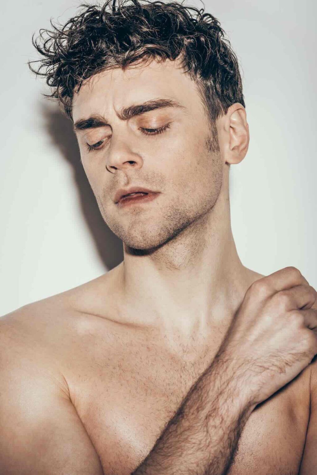 Resultados de marcación mandibular en hombre con ácido hialurónico (modelo)