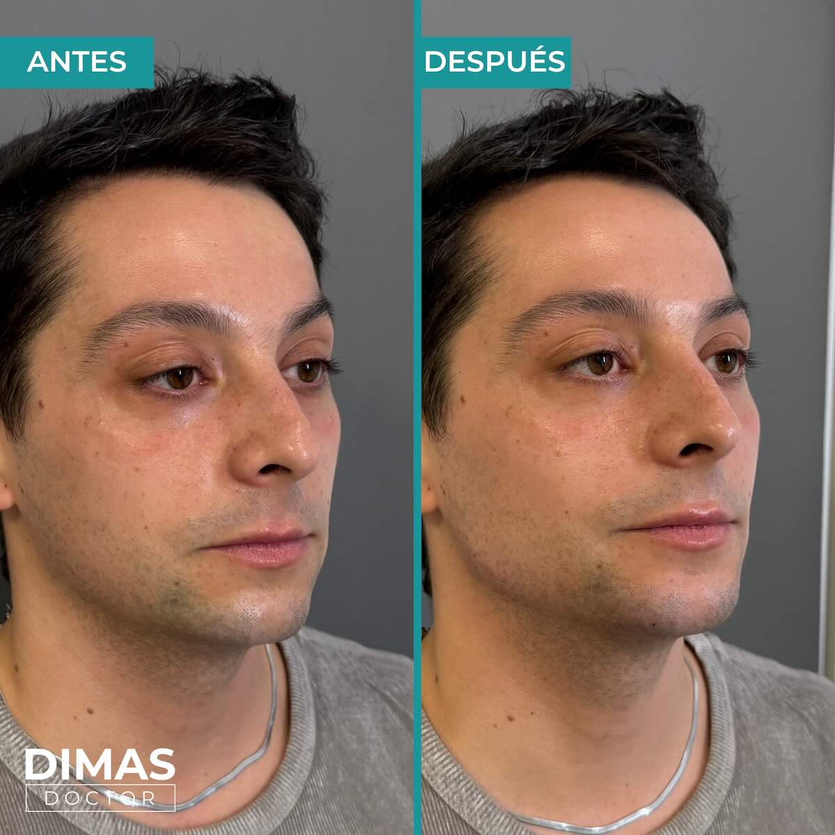 Resultados de marcación mandibular en hombre con ácido hialurónico