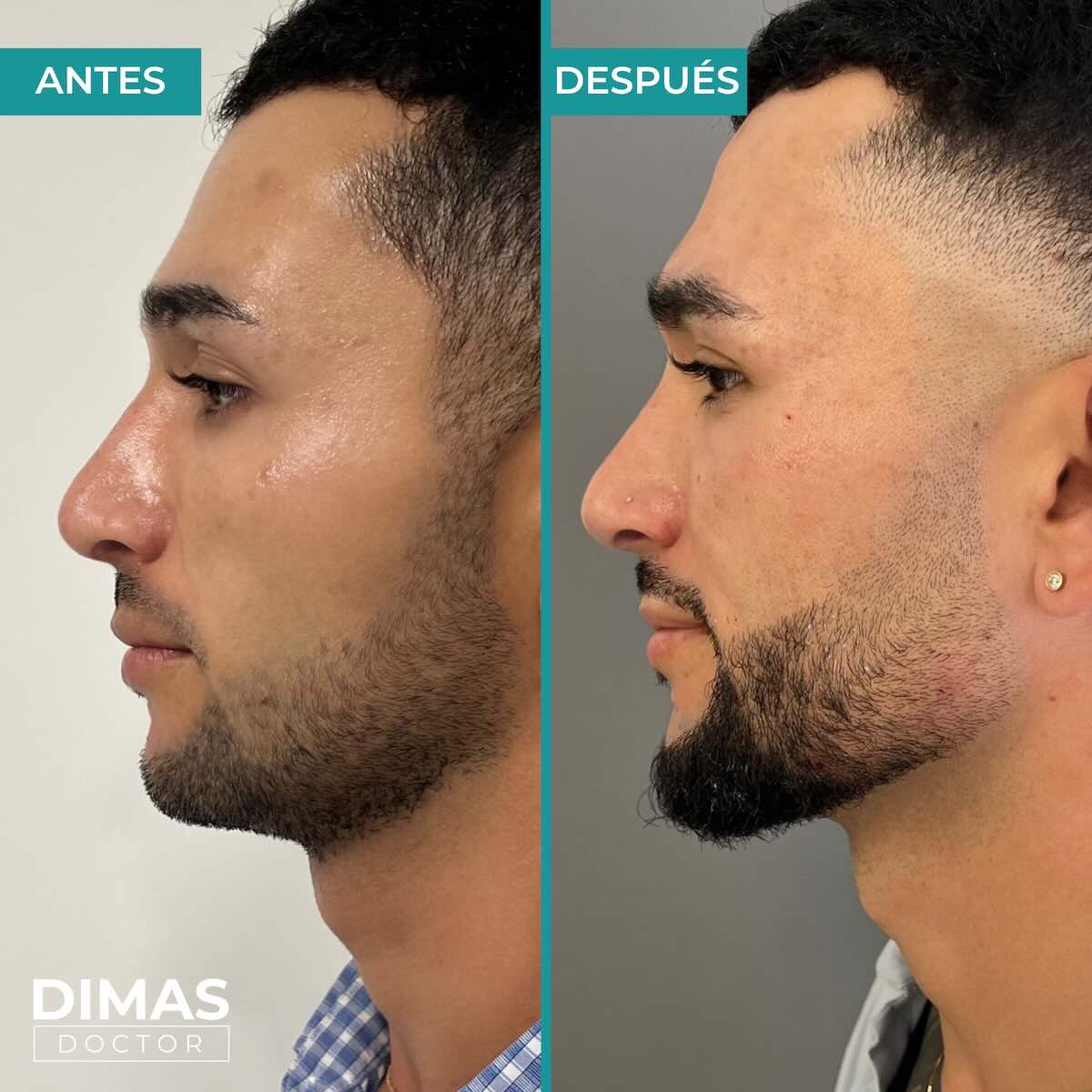 Resultados de marcación mandibular en hombre con ácido hialurónico