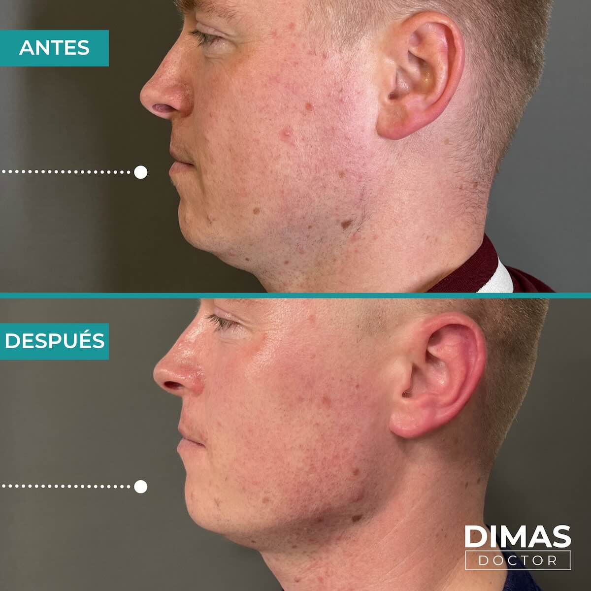 Resultados de marcación mandibular en hombre con ácido hialurónico