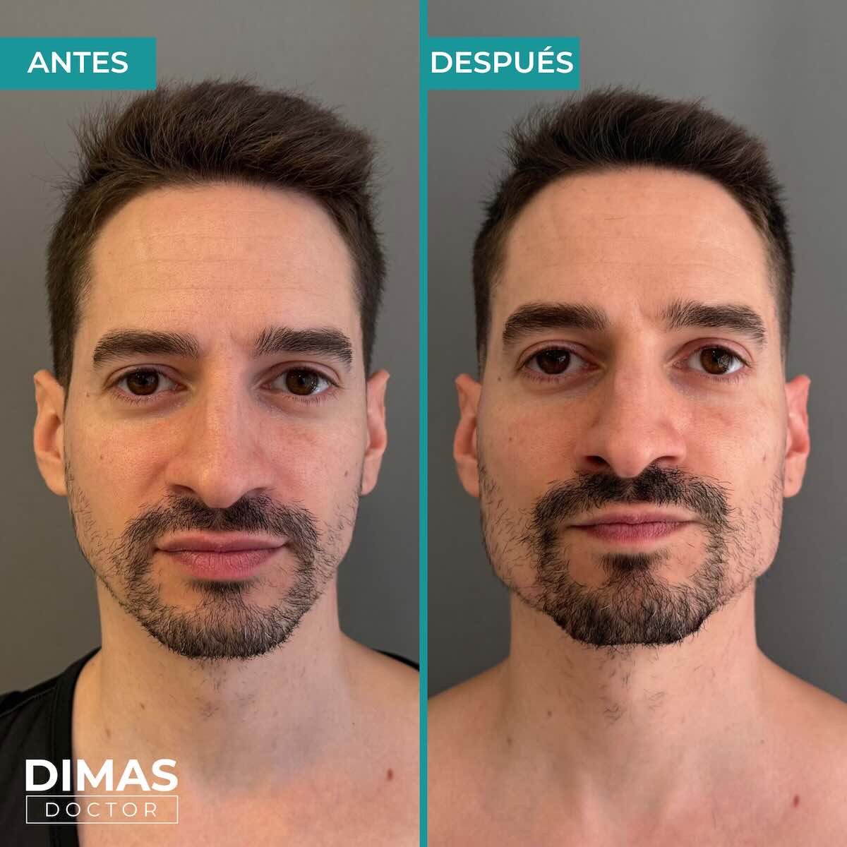 Resultados de marcación mandibular en hombre con ácido hialurónico