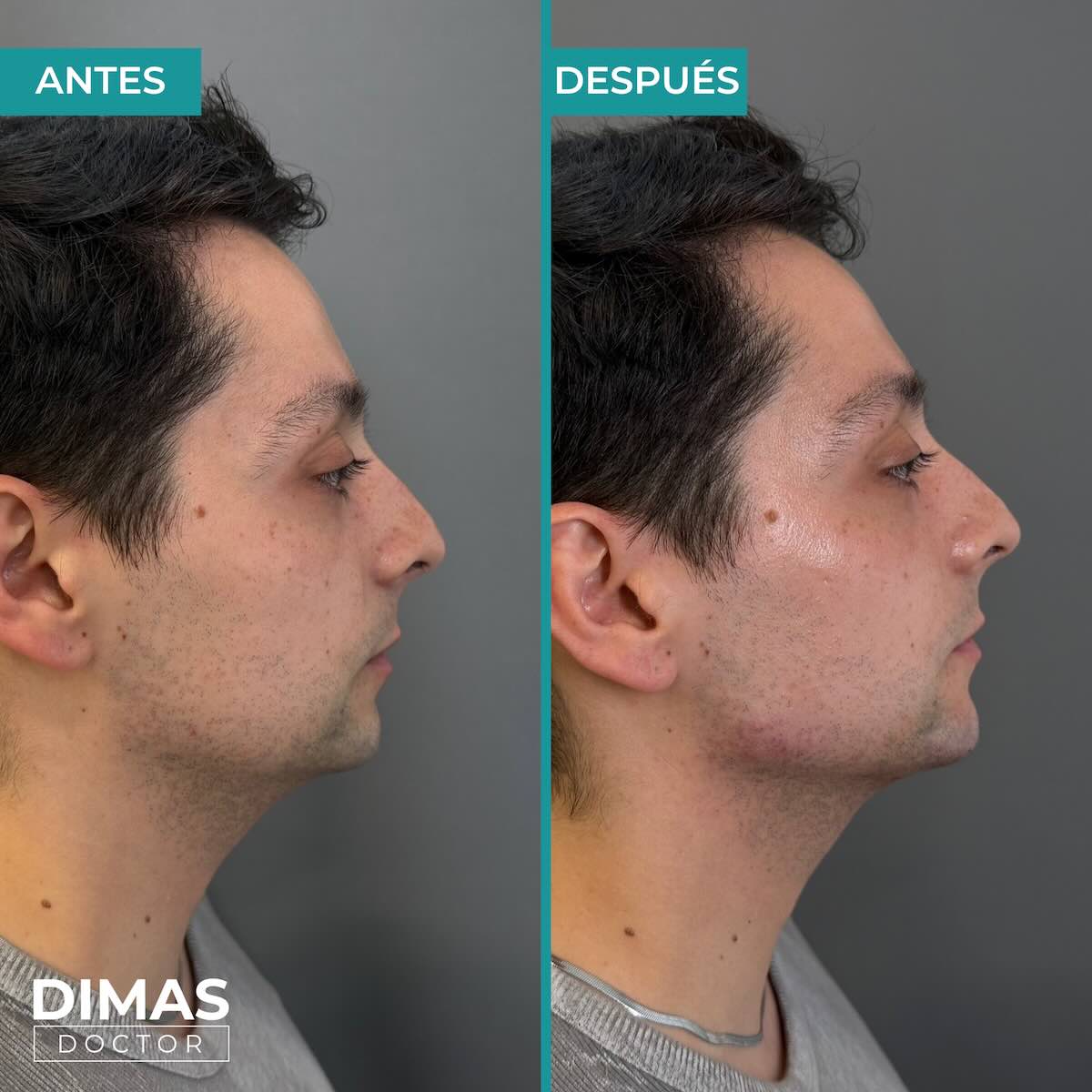 Resultados de marcación mandibular en hombre con ácido hialurónico