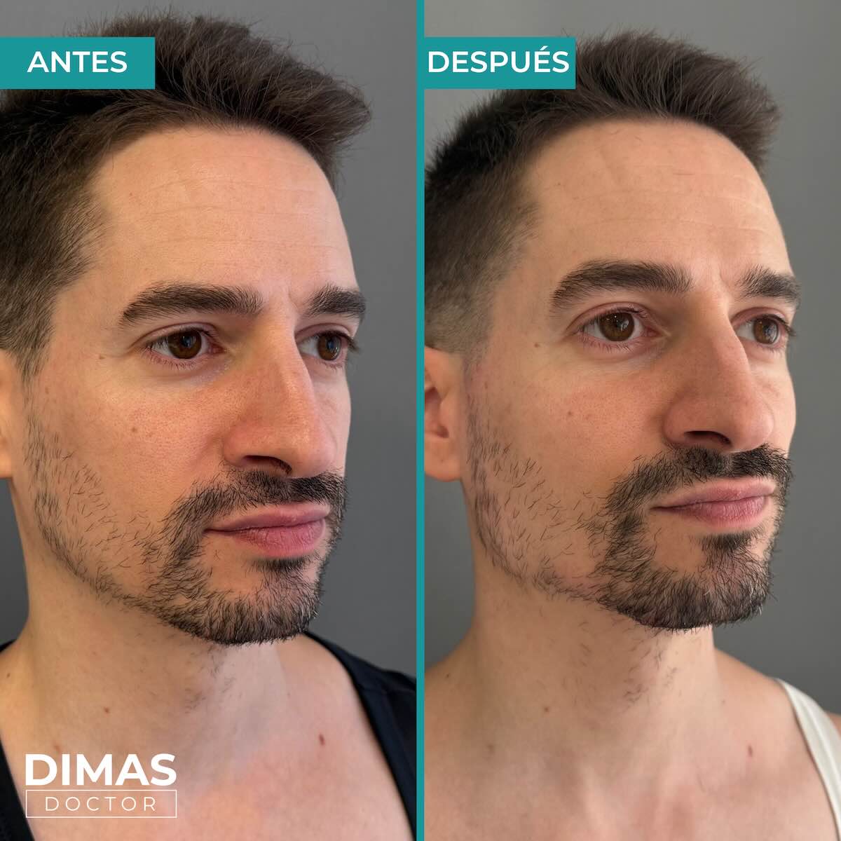 Resultados de marcación mandibular en hombre con ácido hialurónico