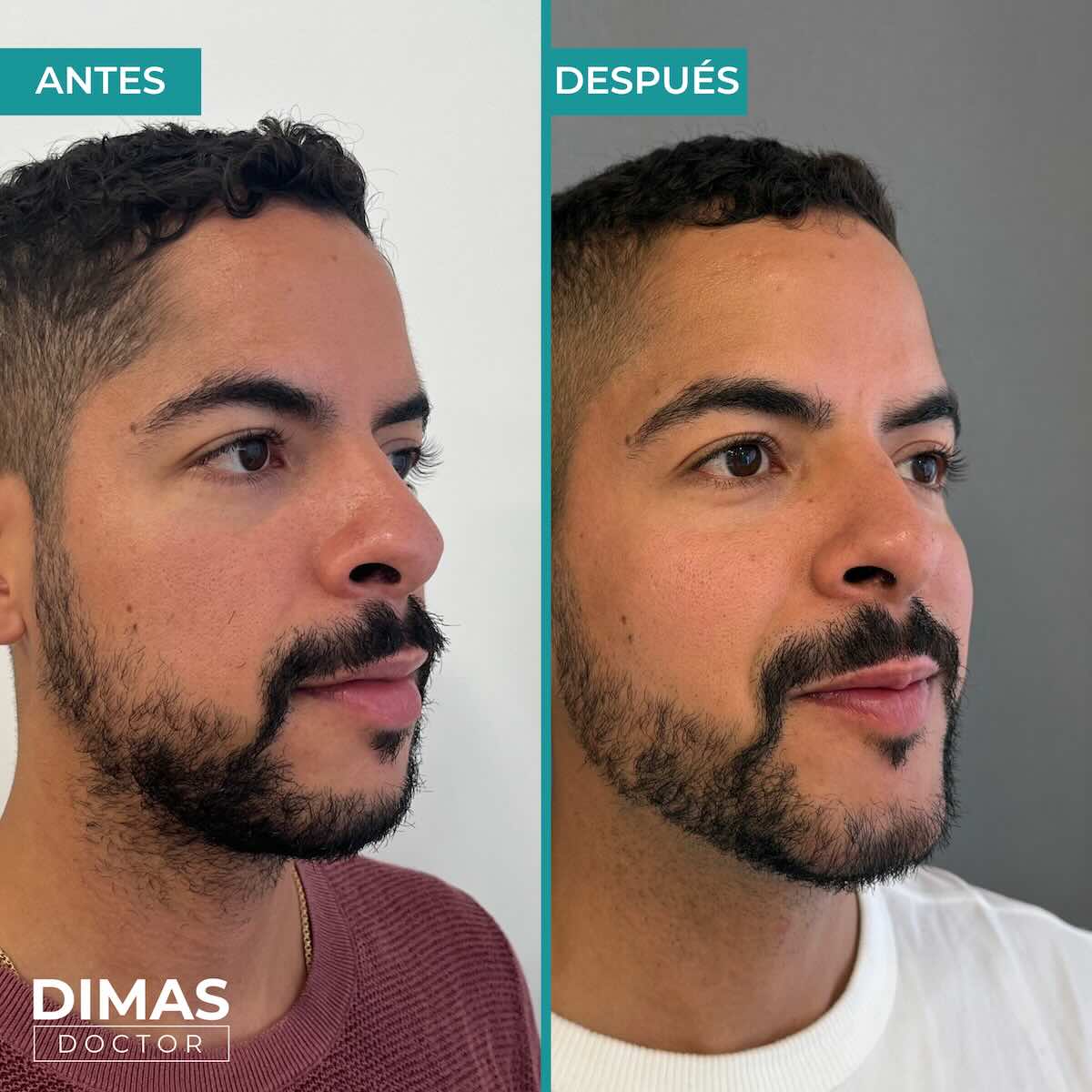 Resultados de marcación mandibular en hombre con ácido hialurónico