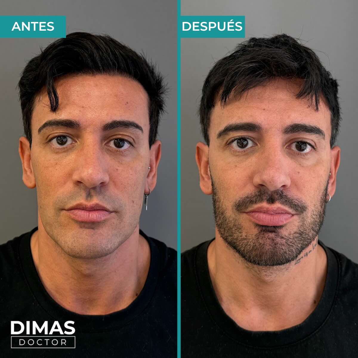 Resultados de marcación mandibular en hombre con ácido hialurónico