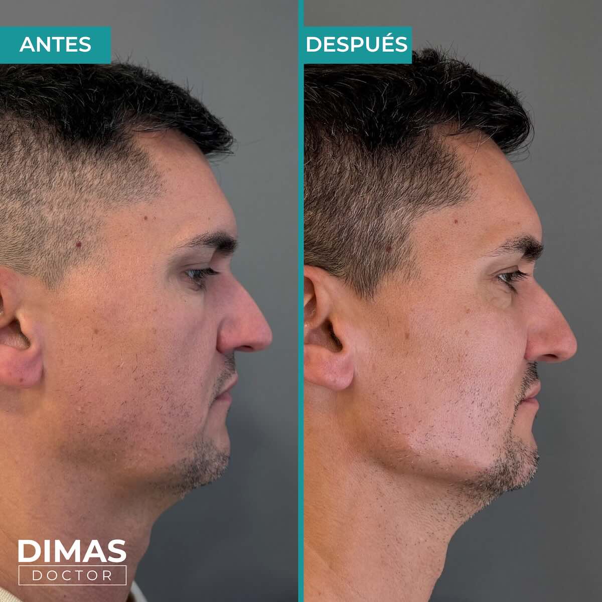 Resultados de marcación mandibular en hombre con ácido hialurónico