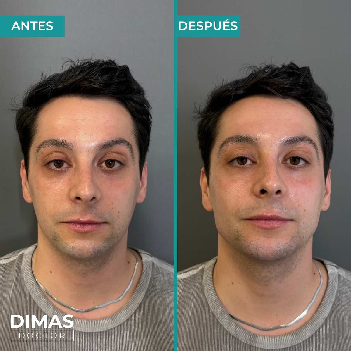 Resultados de marcación mandibular en hombre con ácido hialurónico