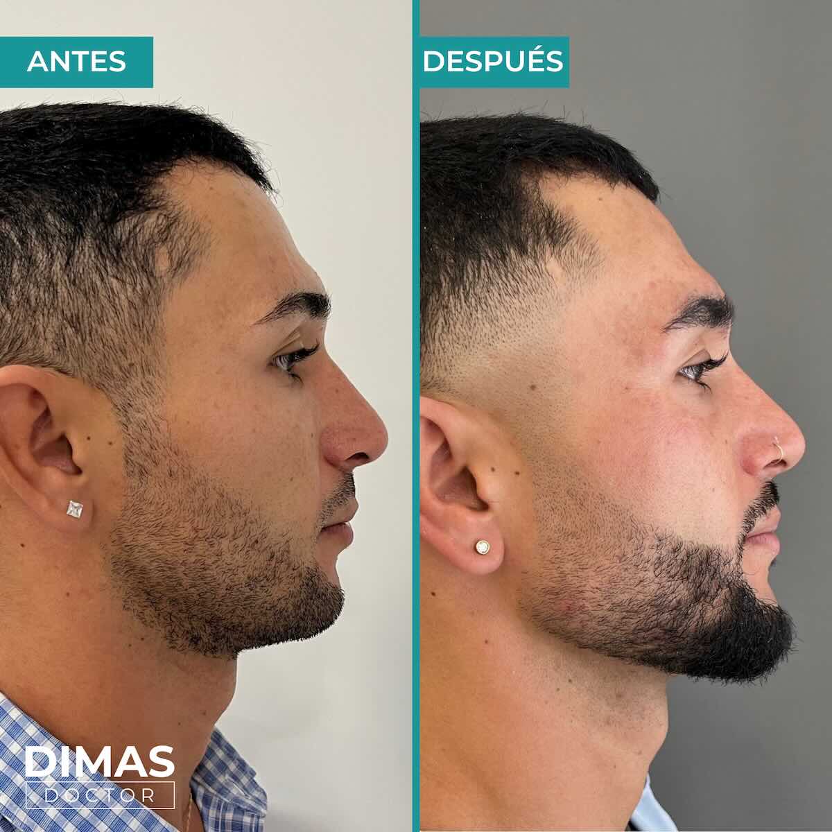 Resultados de marcación mandibular en hombre con ácido hialurónico