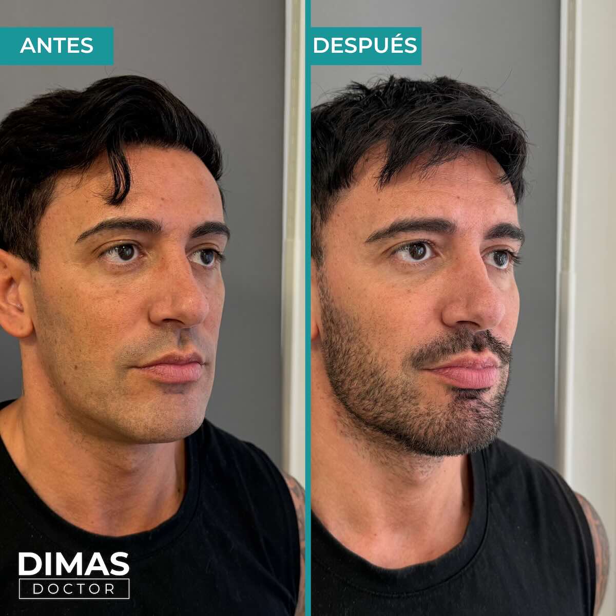 Resultados de marcación mandibular en hombre con ácido hialurónico