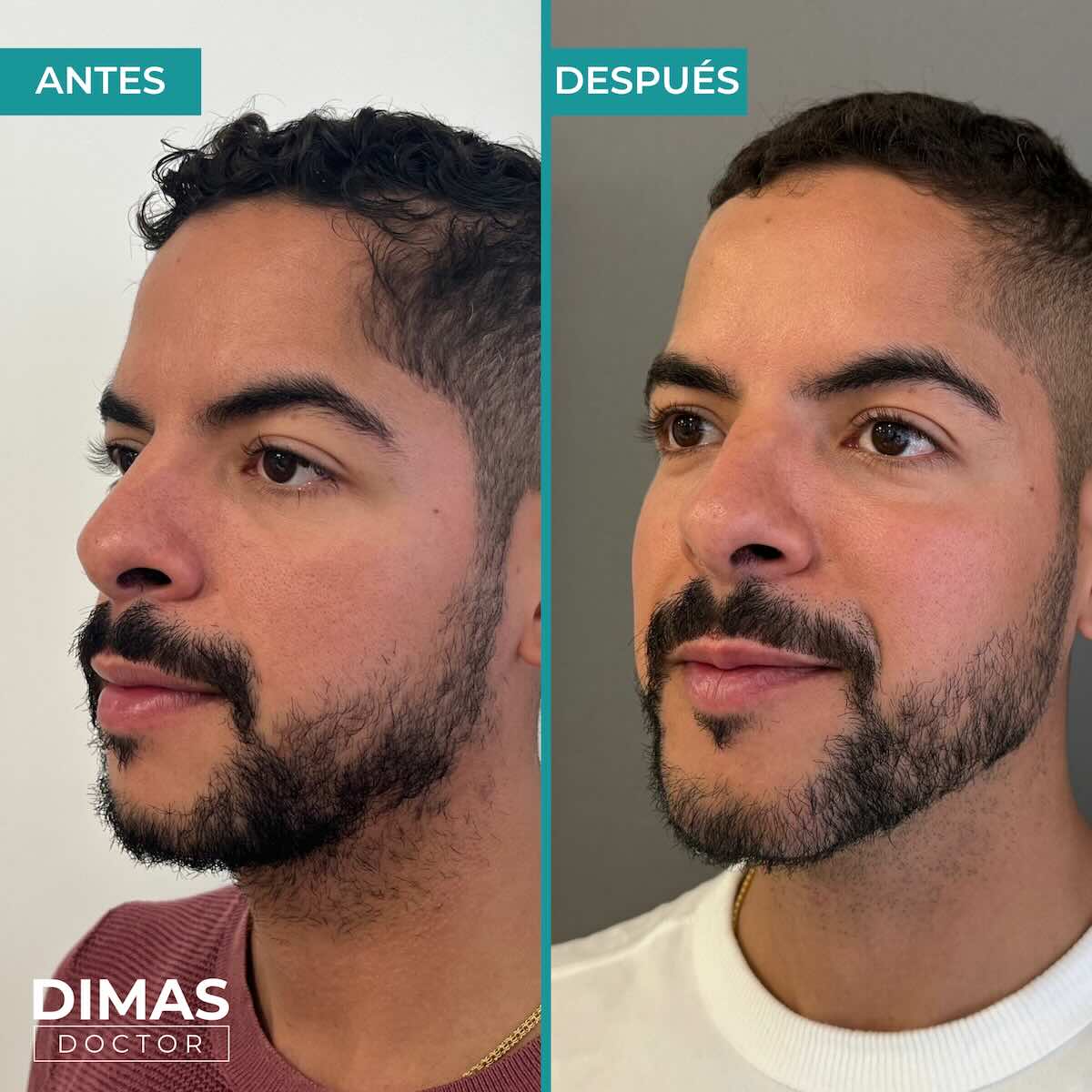 Resultados de marcación mandibular en hombre con ácido hialurónico