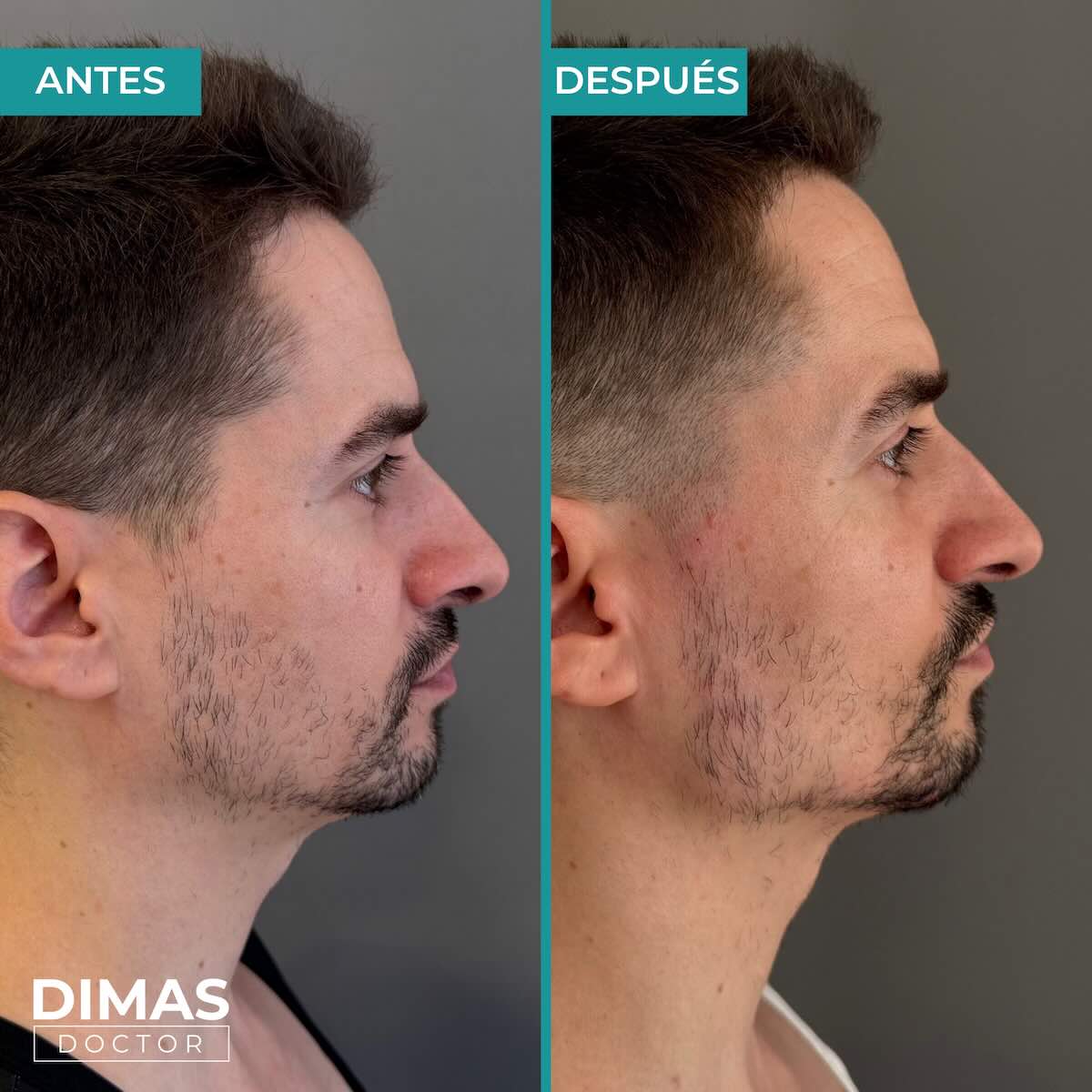 Resultados de marcación mandibular en hombre con ácido hialurónico