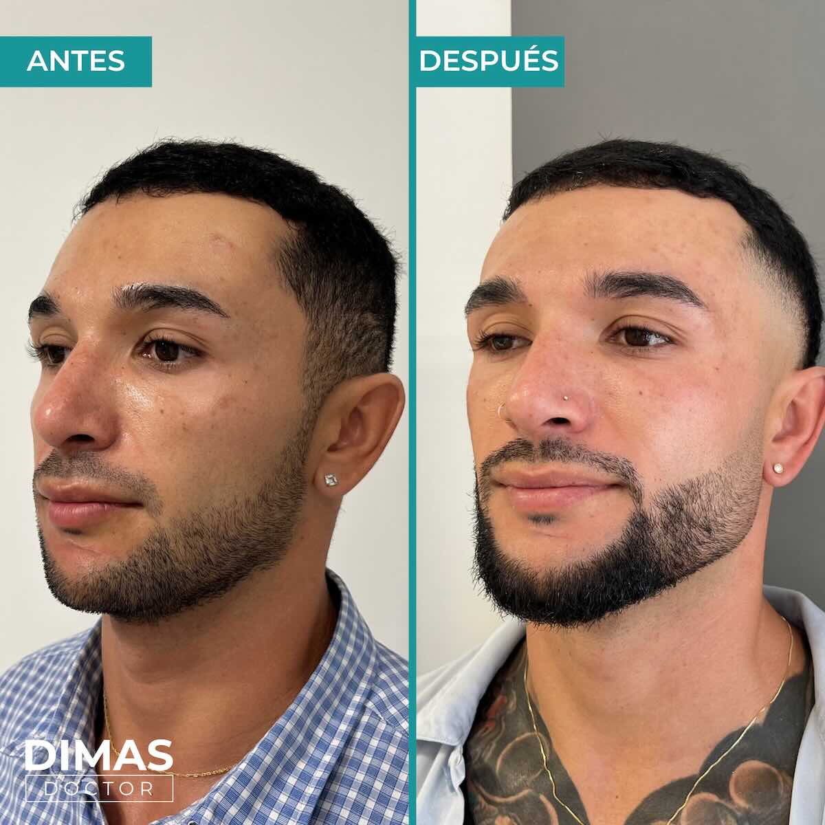 Resultados de marcación mandibular en hombre con ácido hialurónico