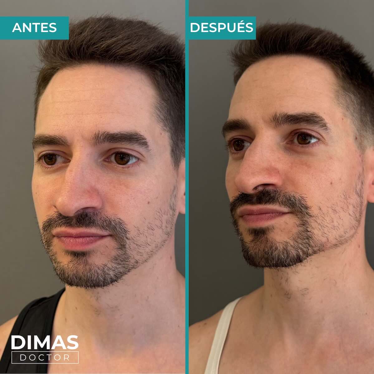 Resultados de marcación mandibular en hombre con ácido hialurónico