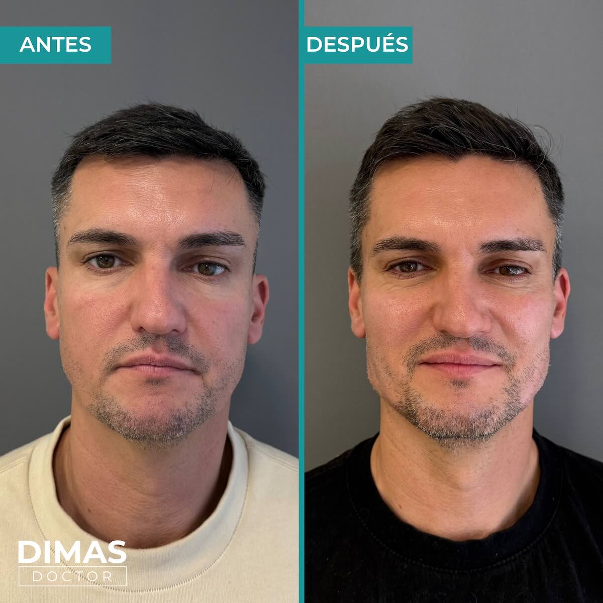 Resultados de marcación mandibular en hombre con ácido hialurónico