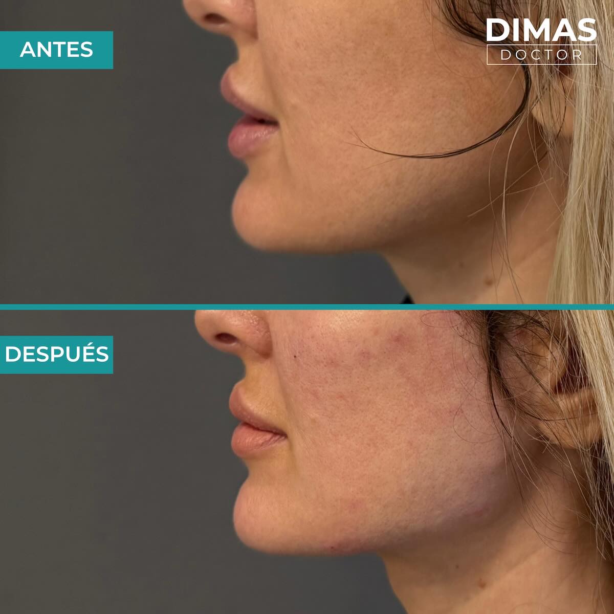 Resultados de marcación mandibular en mujer con ácido hialurónico