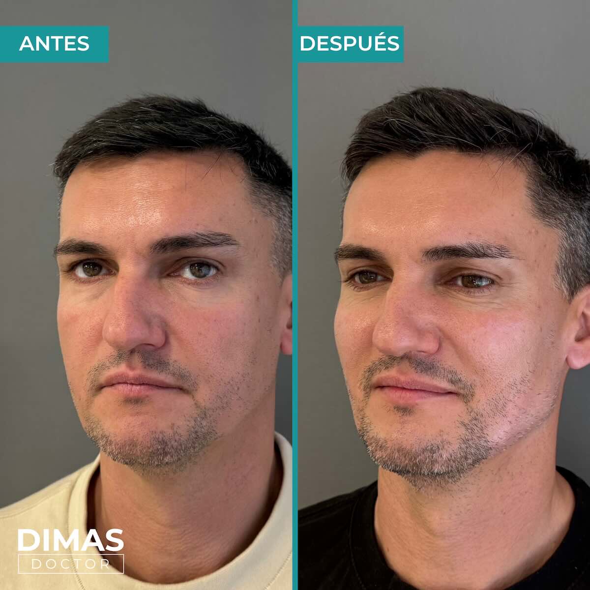 Resultados de marcación mandibular en hombre con ácido hialurónico