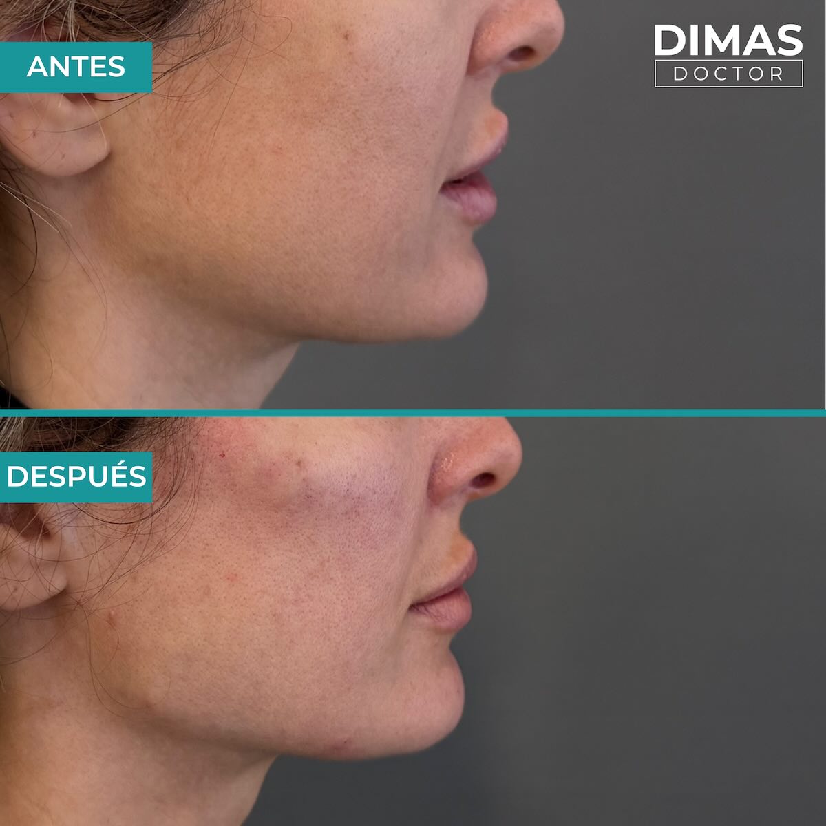 Resultados de marcación mandibular en mujer con ácido hialurónico