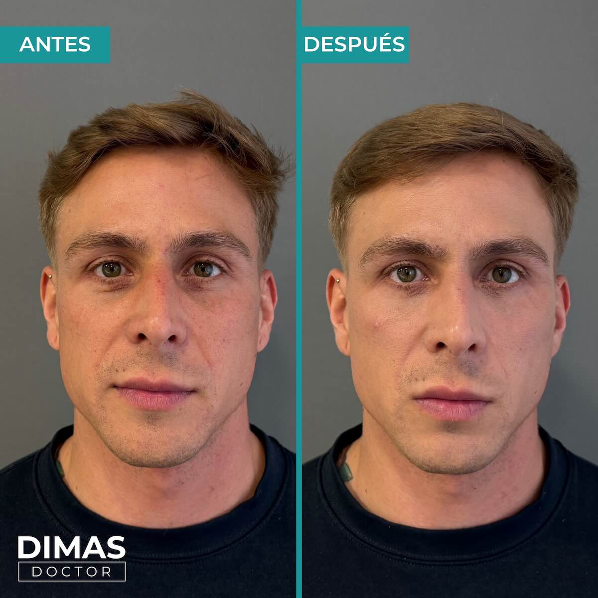 Antes y después en hombre tras el tratamiento de relleno de ojeras con ácido hialurónico en barcelona