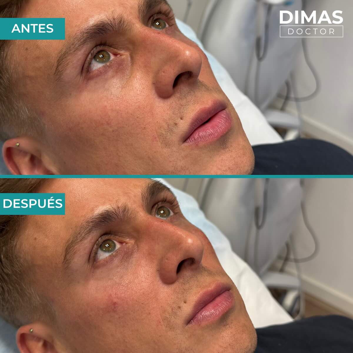 Antes y después en hombre tras el tratamiento de relleno de ojeras con ácido hialurónico en barcelona