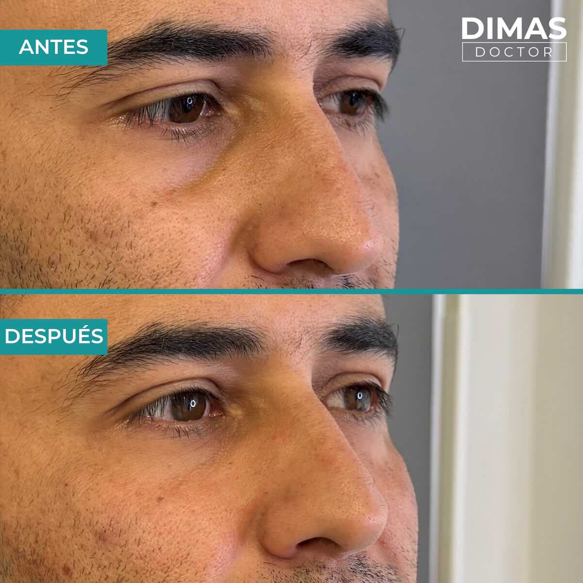 Antes y después en hombre tras el tratamiento de relleno de ojeras con ácido hialurónico en barcelona