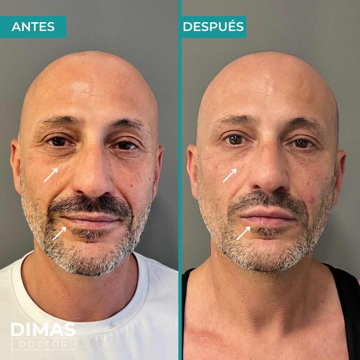 Antes y después en hombre tras el tratamiento de relleno de ojeras con ácido hialurónico en barcelona