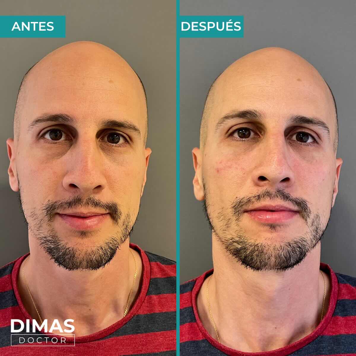 Antes y después en hombre tras el tratamiento de relleno de ojeras con ácido hialurónico en barcelona
