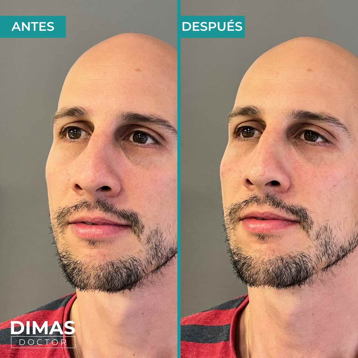 Antes y después en hombre tras el tratamiento de relleno de ojeras con ácido hialurónico en barcelona
