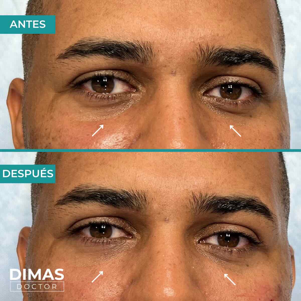 Antes y después en hombre tras el tratamiento de relleno de ojeras con ácido hialurónico en barcelona