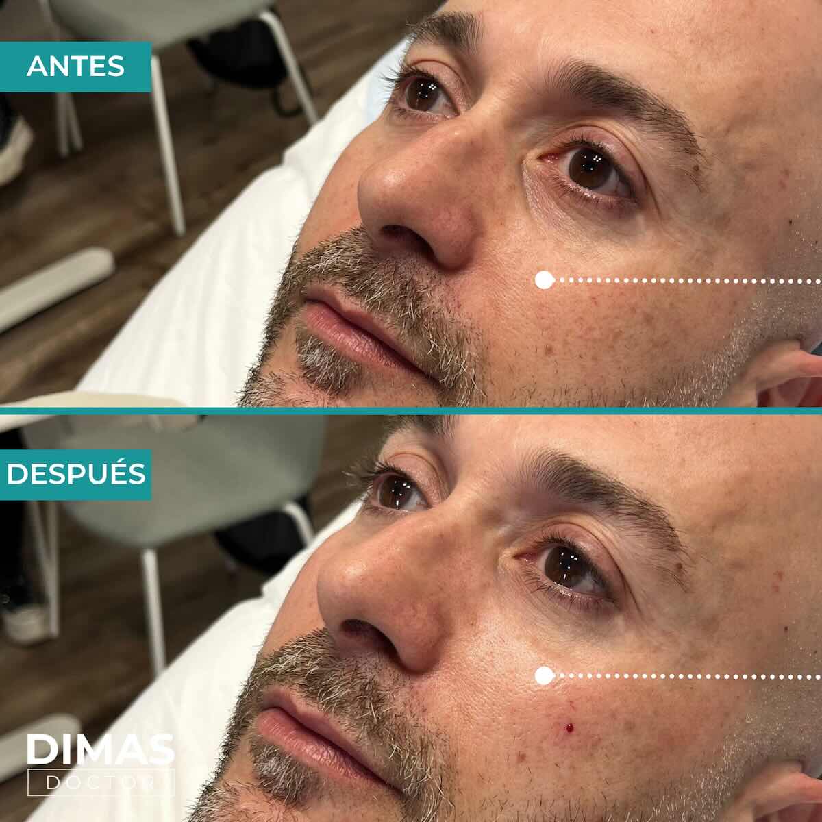 Antes y después en hombre tras el tratamiento de relleno de ojeras con ácido hialurónico en barcelona