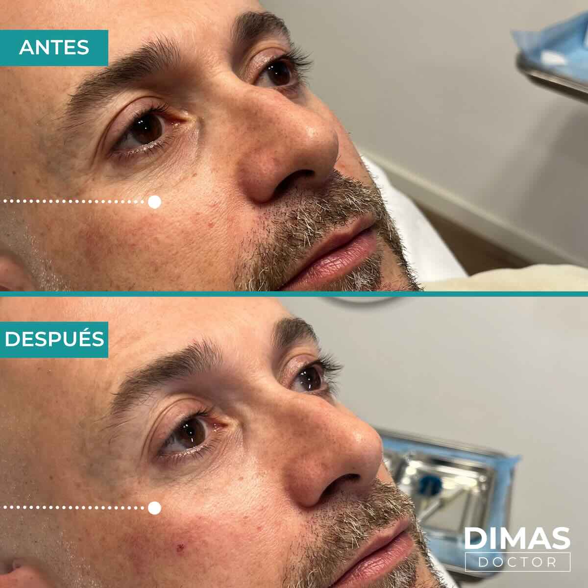 Antes y después en hombre tras el tratamiento de relleno de ojeras con ácido hialurónico en barcelona