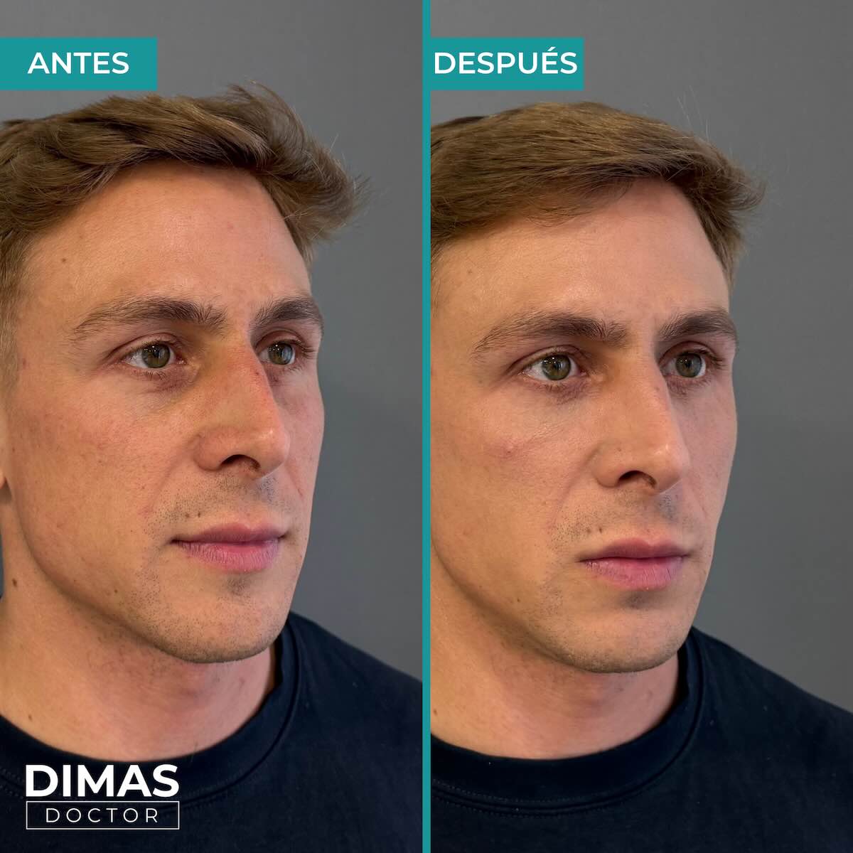 Antes y después en hombre tras el tratamiento de relleno de ojeras con ácido hialurónico en barcelona