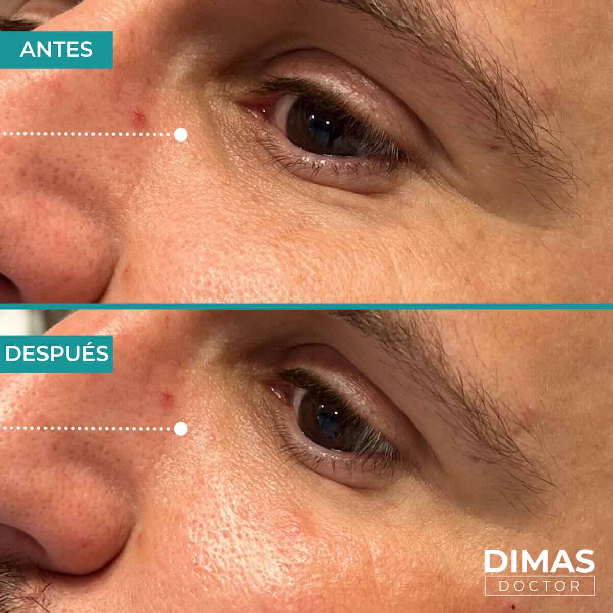 Antes y después en hombre tras el tratamiento de relleno de ojeras con ácido hialurónico en barcelona